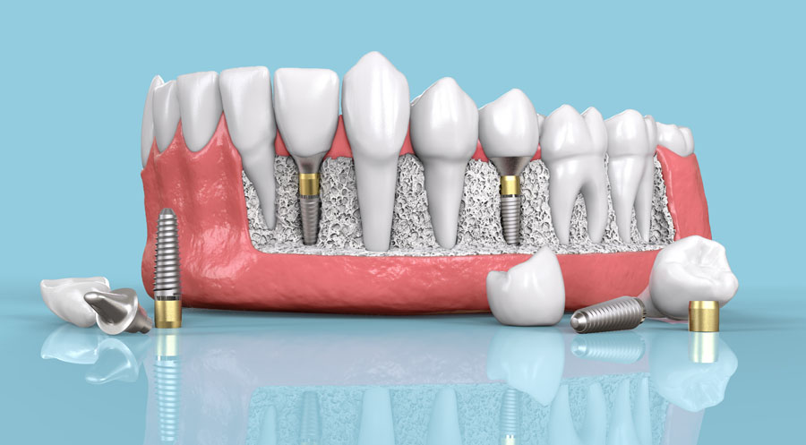 Implantáty model