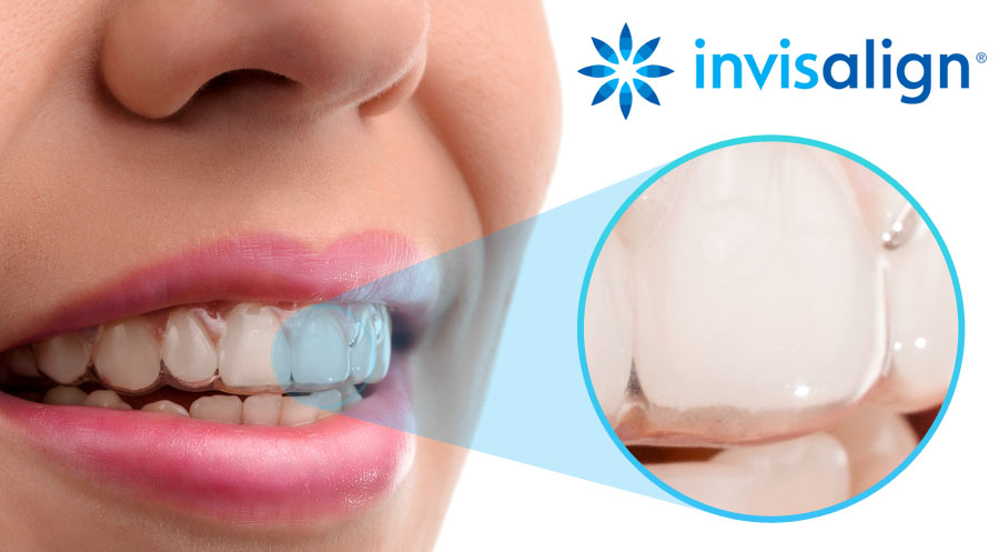 Invisalign