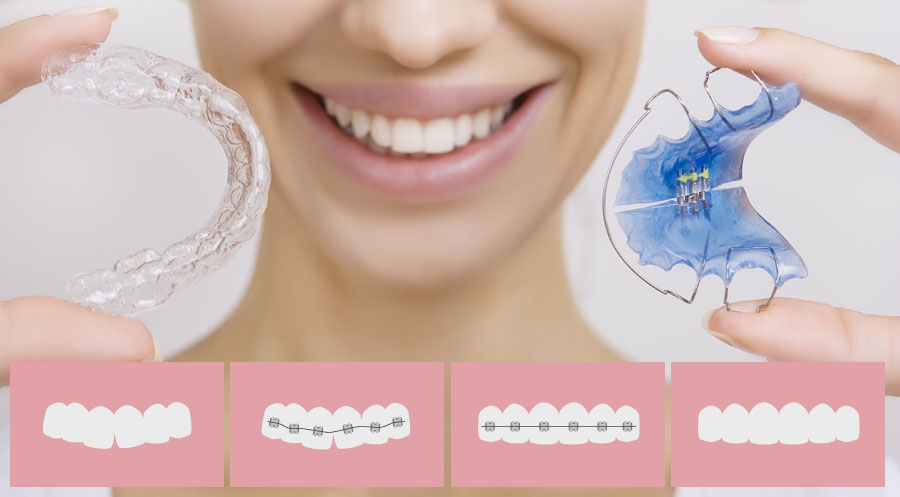 Progress s rovnátky i s invisalign