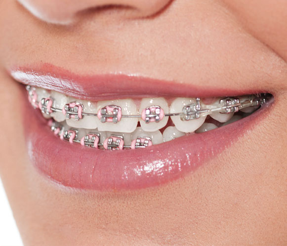 Invisible aligners Invisalign